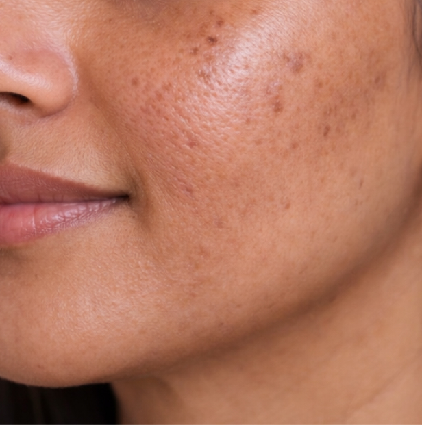 chemical Peel before