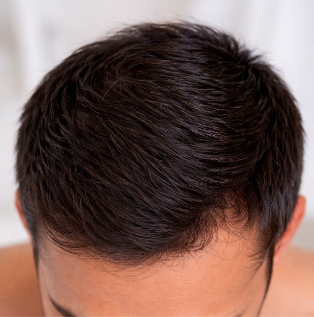 dandruff treatment kochi after