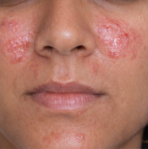 skin allergy treatment kochi before