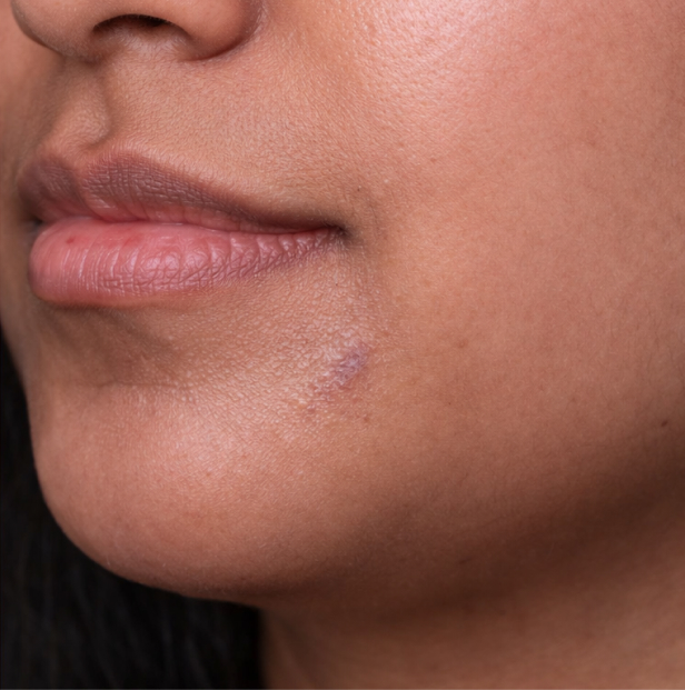 skin tag removal after