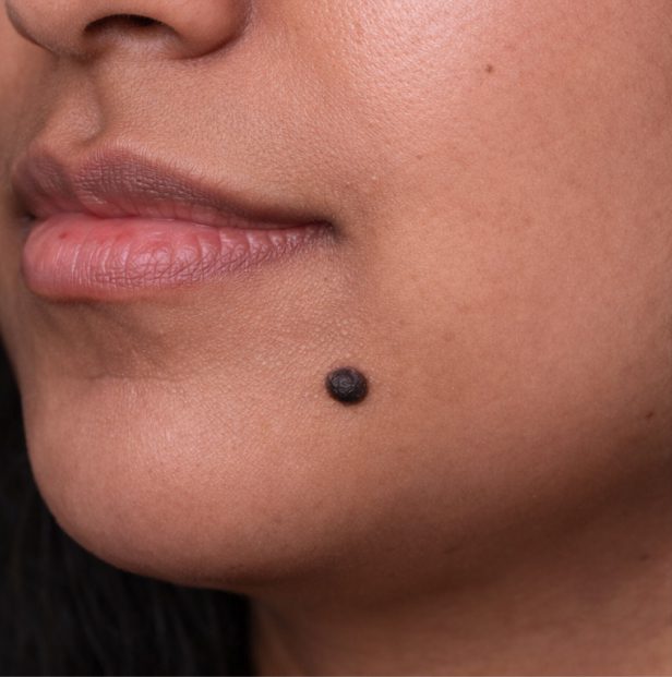 skin tag removal before