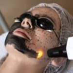 carbon peel in kochi