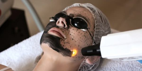 carbon peel in kochi