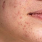 Dark Spot Removal