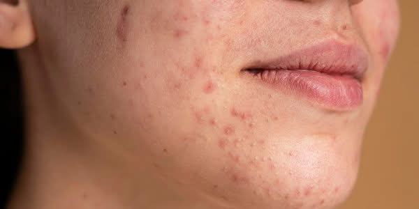 Dark Spot Removal