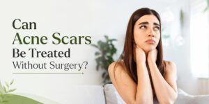 Can Acne Scars Be Treated Without Surgery?