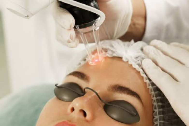 Fractional laser treatment for acne scars and skin texture