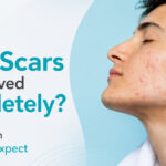 can deep acne scars be completely removed