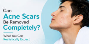 Can Acne Scars Be Removed Completely? What You Can Realistically Expect