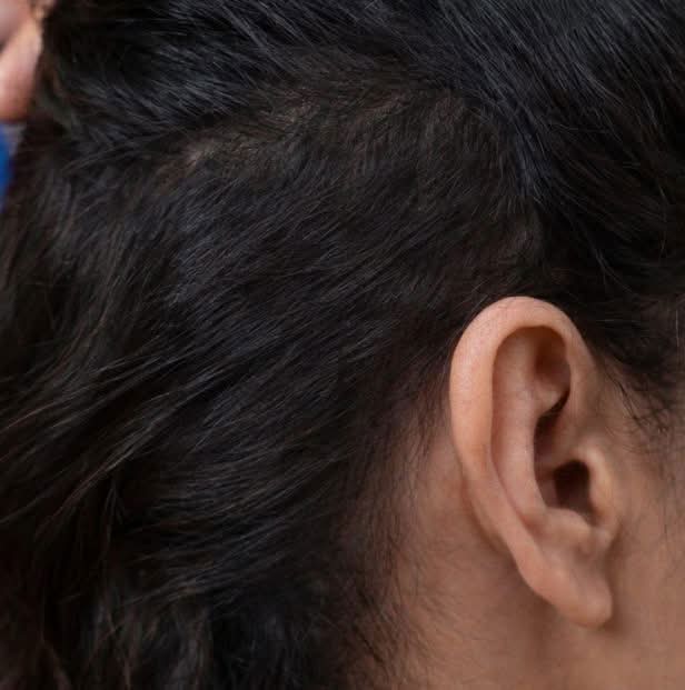 prp hair after results