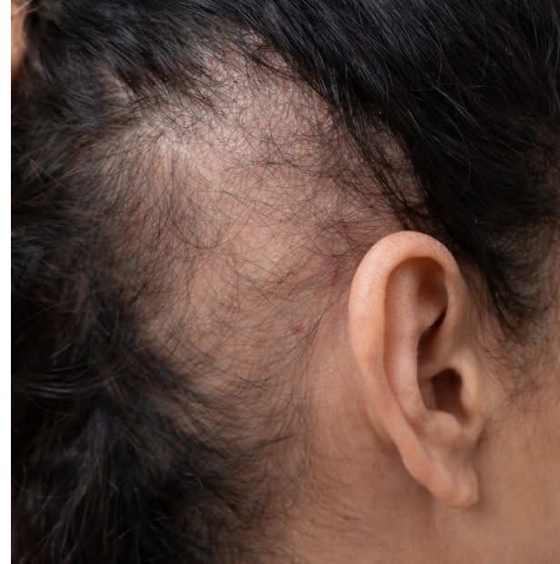 prp hair before results