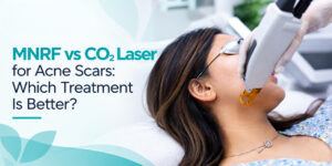 MNRF vs CO2 Laser for Acne Scars: Which Treatment Is Better?