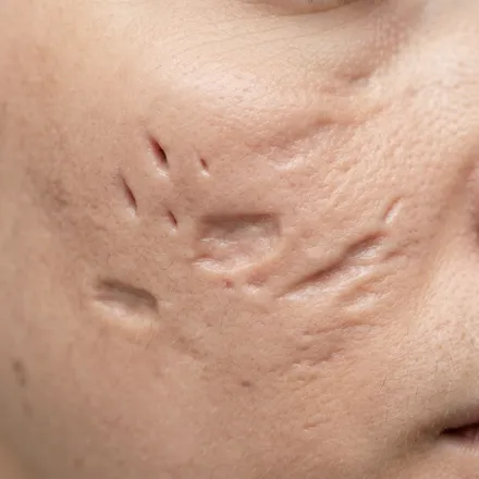 Dermatologist in Kadavanthra, Kochi 12 Close-up of skin texture with acne scars