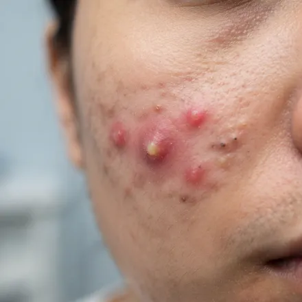 Dermatologist in Kadavanthra, Kochi 10 Close-up of skin with active acne breakouts