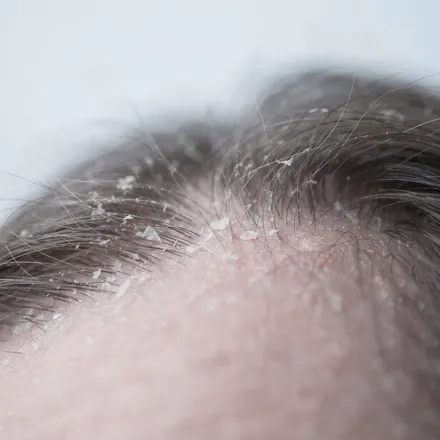Dermatologist in Kadavanthra, Kochi 16 Scalp with dandruff flakes