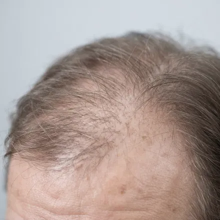Dermatologist in Kadavanthra, Kochi 14 Thinning hair at the crown showing hair loss