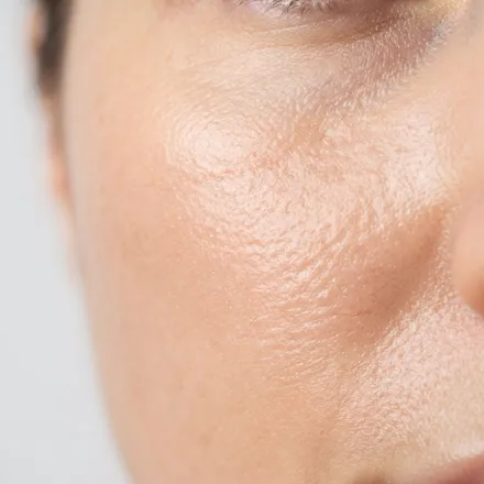 Dermatologist in Kadavanthra, Kochi 24 Close-up of facial skin for dermatologist consultation
