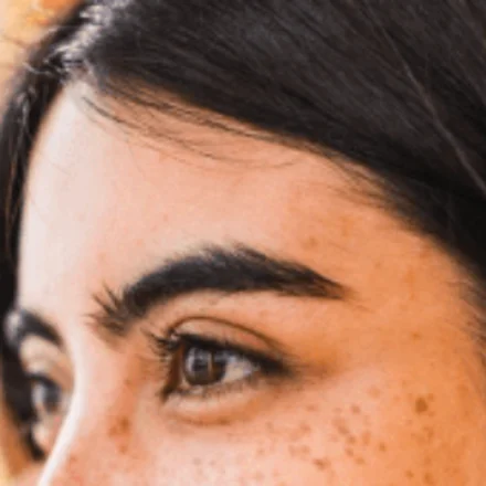 Dermatologist in Kadavanthra, Kochi 18 Freckles and pigmentation on facial skin