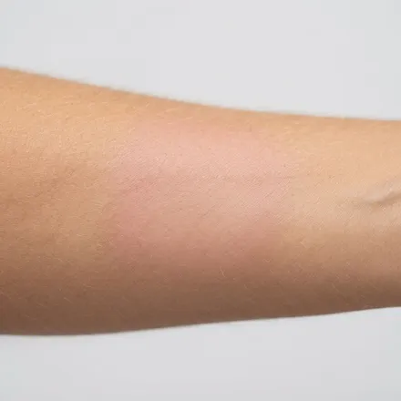 Dermatologist in Kadavanthra, Kochi 20 Smooth arm after laser hair reduction