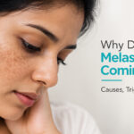 melasma pigmentation