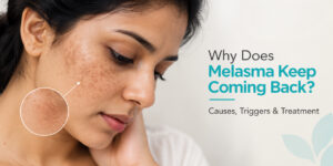 Why Does Melasma Keep Coming Back? Causes, Triggers & Treatment