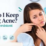 Acne Breakouts