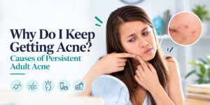 Why Do I Keep Getting Acne? Causes of Persistent Adult Acne